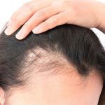 Como fazer o cabelo feminino crescer nas entradas, dicas e tratamentos.